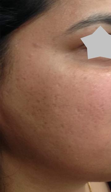 RF Microneedling Treatments Located in Edgewater, NJ