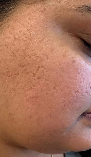 RF Microneedling Treatments Located in Edgewater, NJ