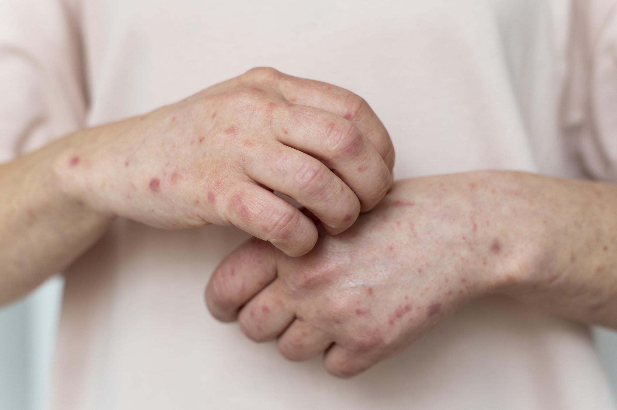 What Is Eczema