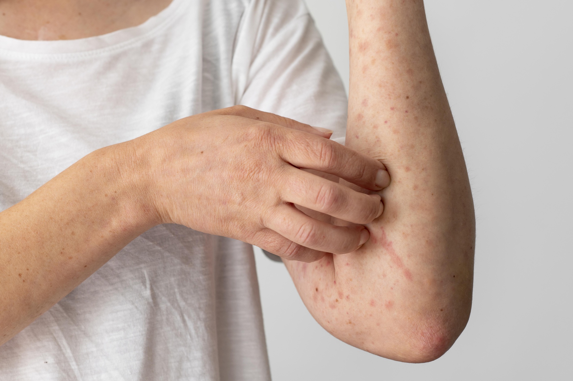 Kinds of Eczema