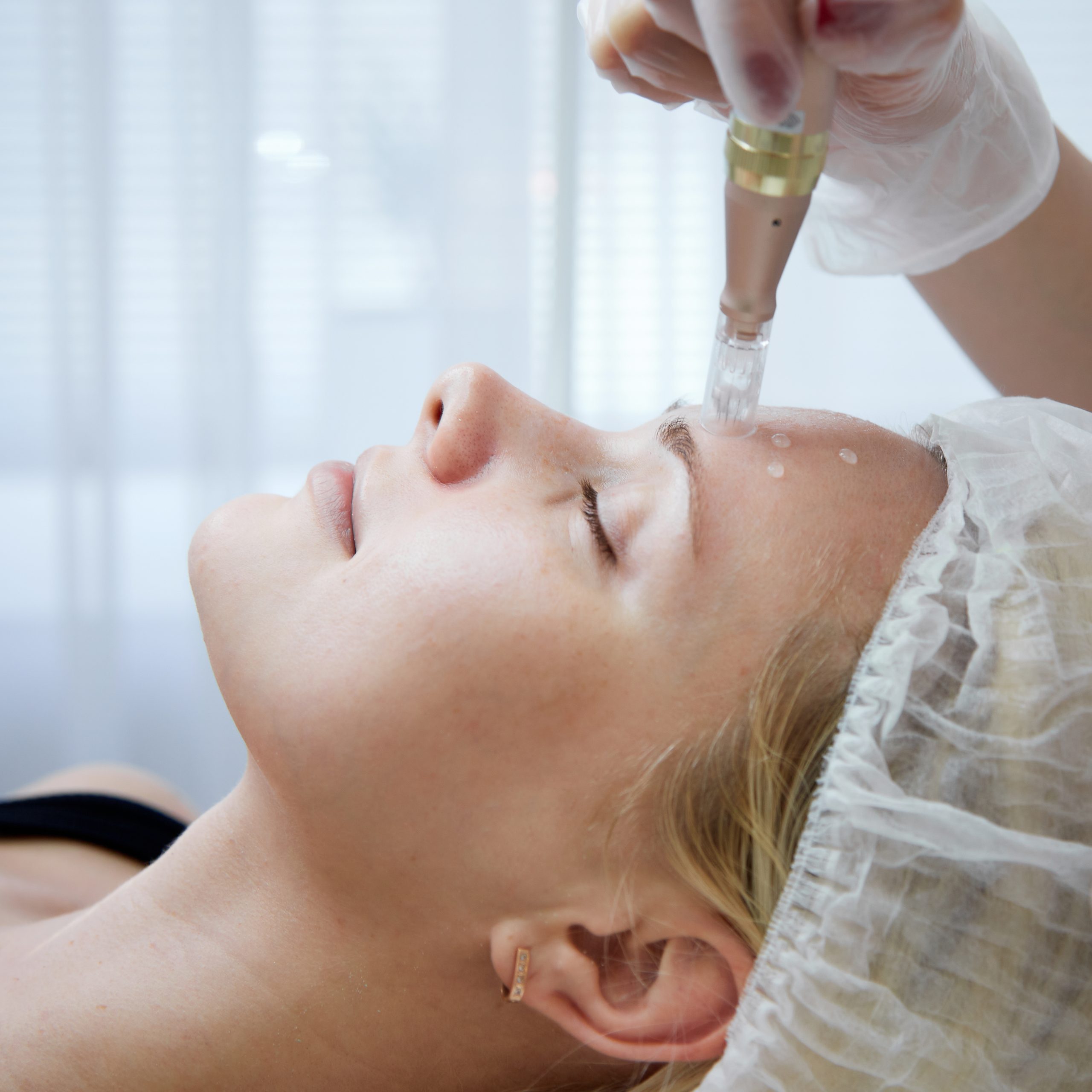 What to Expect After a TCA Chemical Peel