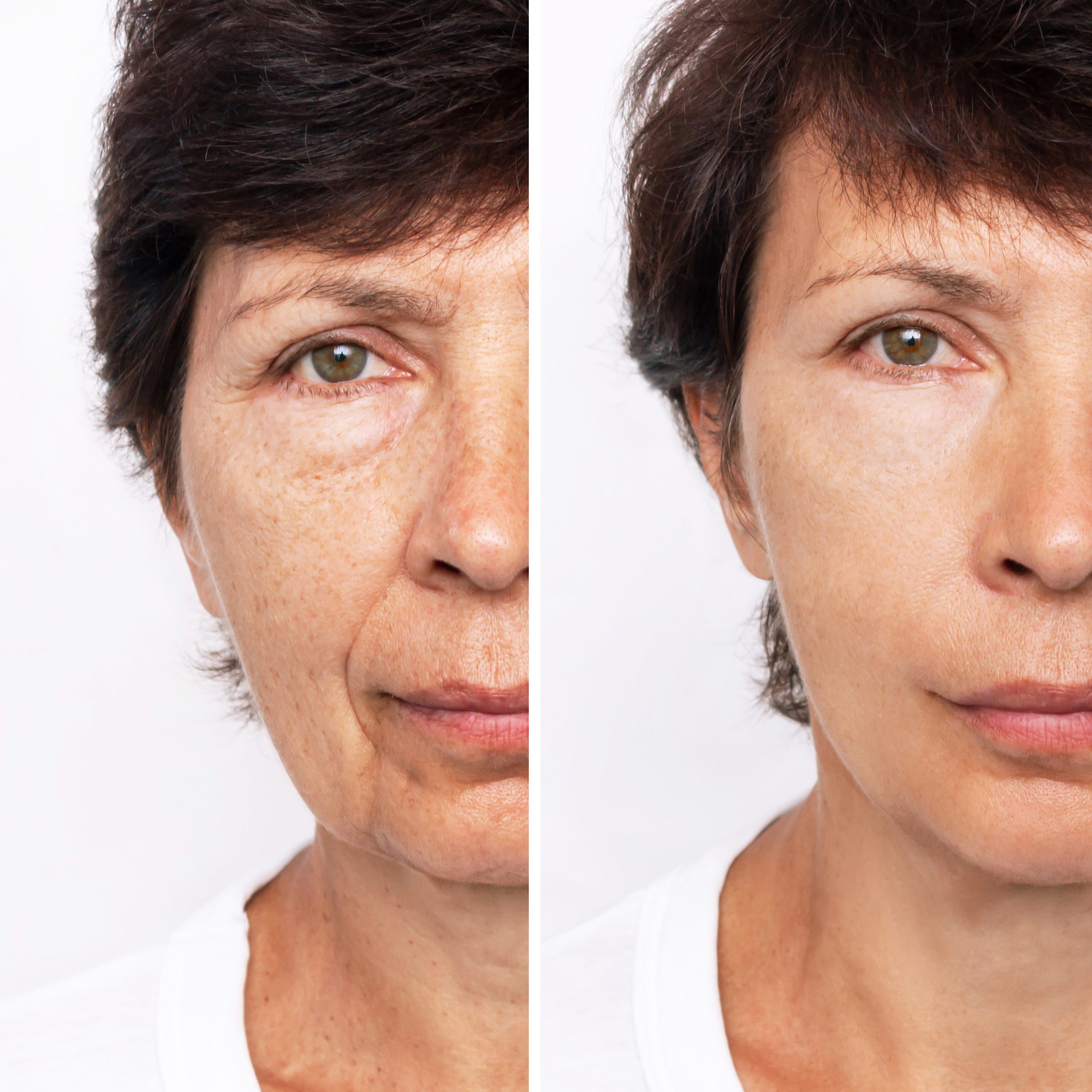 Woman with glowing, smooth skin after PRX Treatment targeting wrinkles, uneven texture, and acne scars.