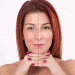 Before and after chemical peel for wrinkles at Bergen Premier Aesthetics