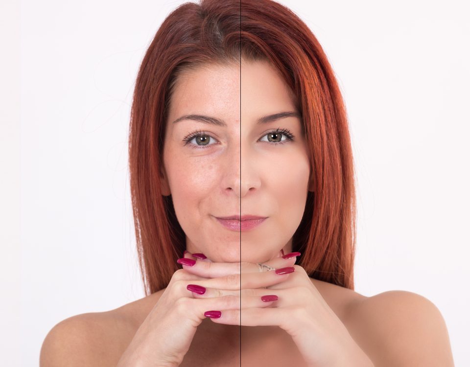 Before and after chemical peel for wrinkles at Bergen Premier Aesthetics
