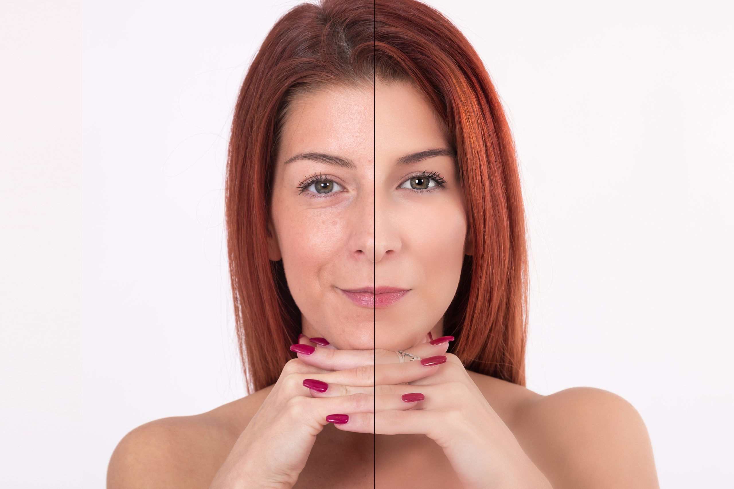 Before and after chemical peel for wrinkles at Bergen Premier Aesthetics