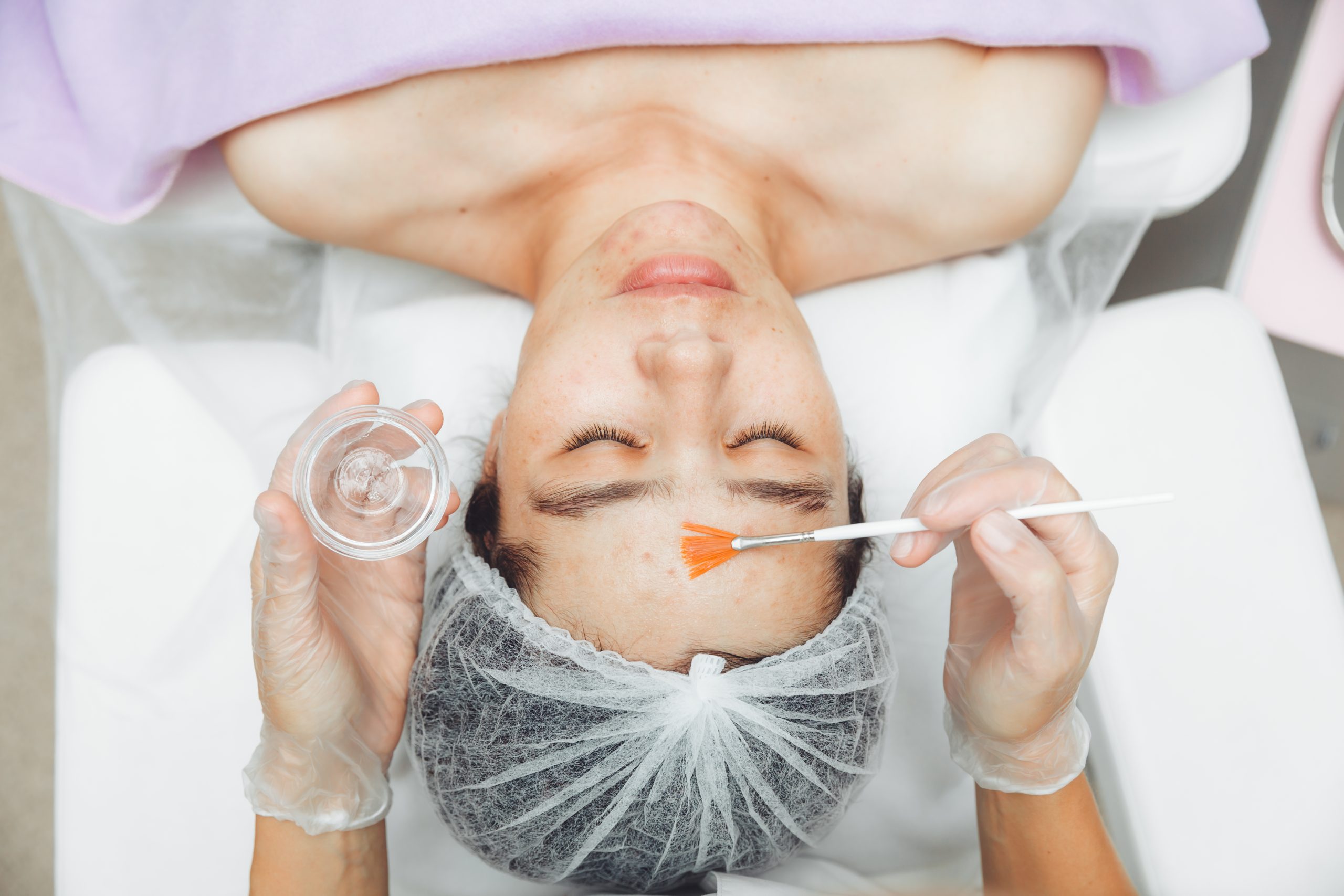 Diagram of chemical peel process for wrinkle reduction