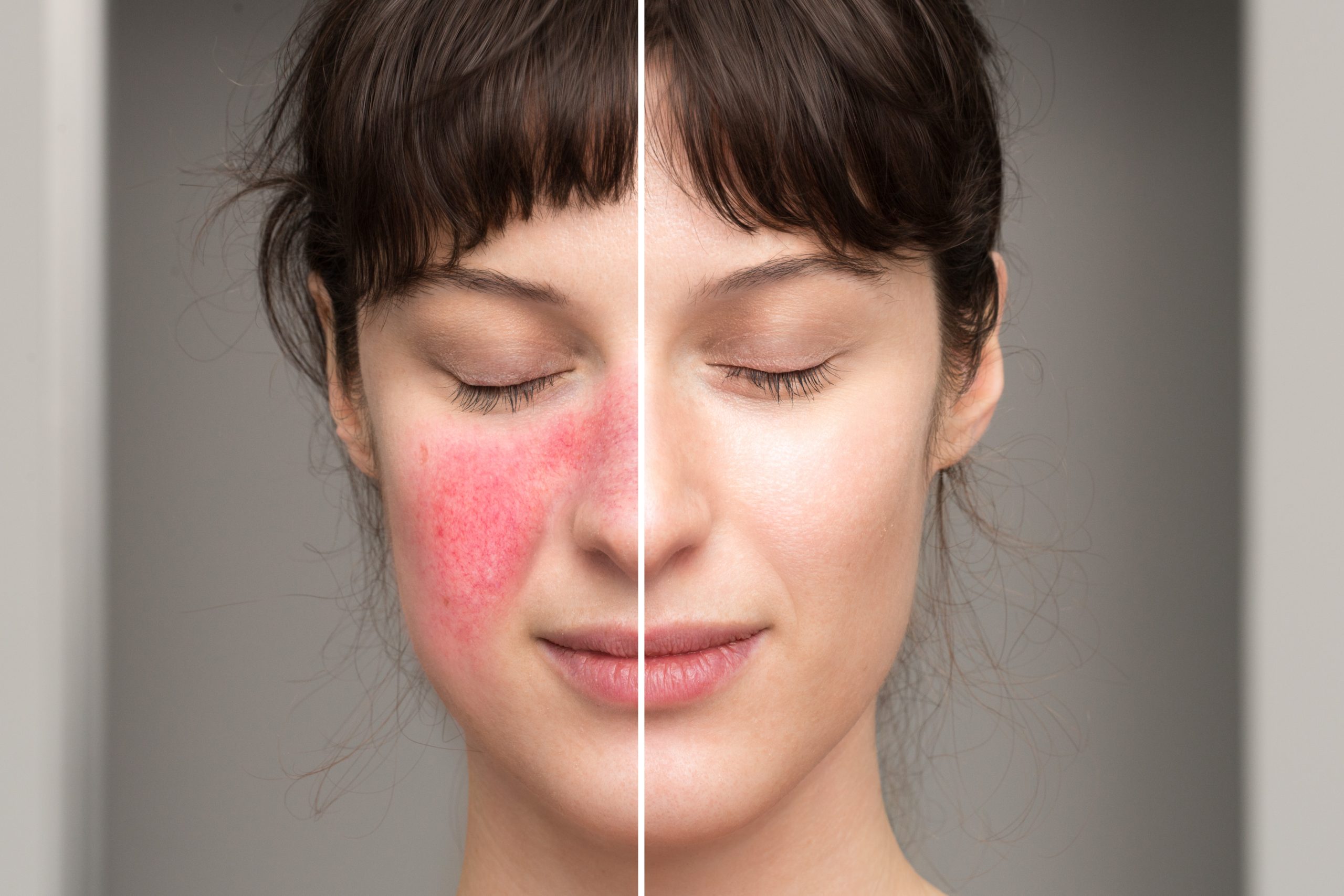Before and after Laser Genesis skin results