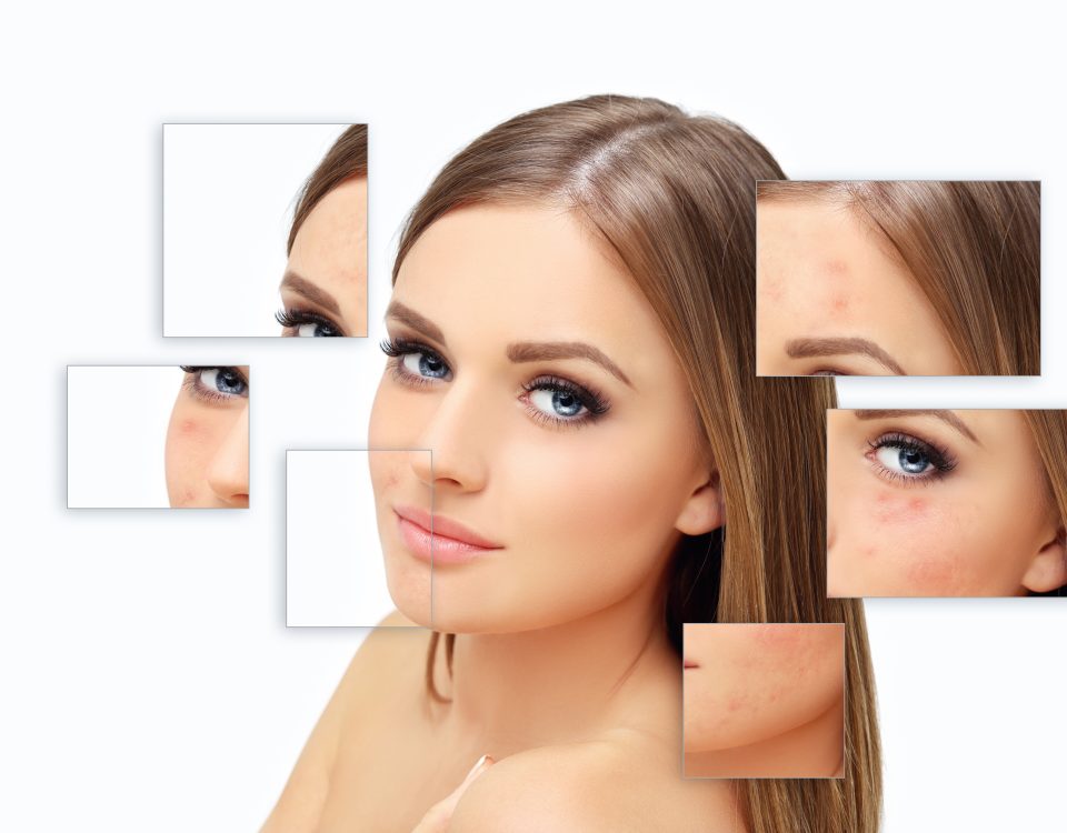 Before and after chemical peel for acne scars at Bergen Premier Aesthetics
