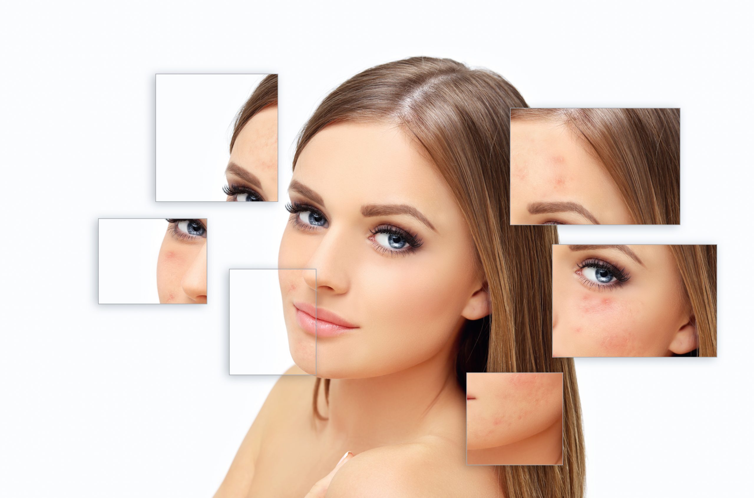 Before and after chemical peel for acne scars at Bergen Premier Aesthetics